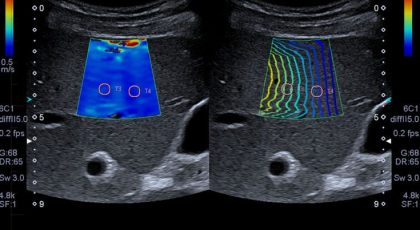 Elastografia Hepática 2D ShearWave